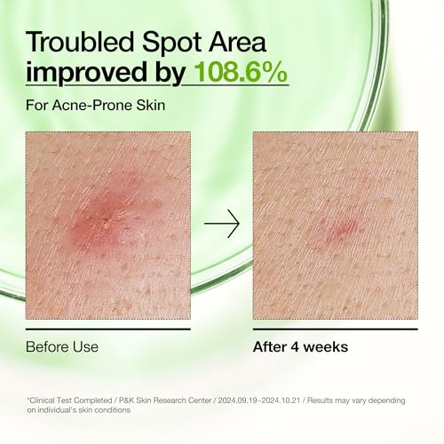 Anua Dúo Verano | Anua Azelaic Acid 10 Hyaluron Enrojecimiento Suer...