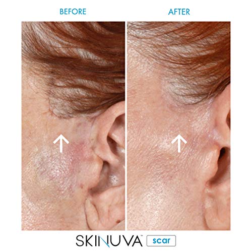 Skinuva® Crema para cicatrices para cara y cuerpo (1.5 onzas) (paqu...