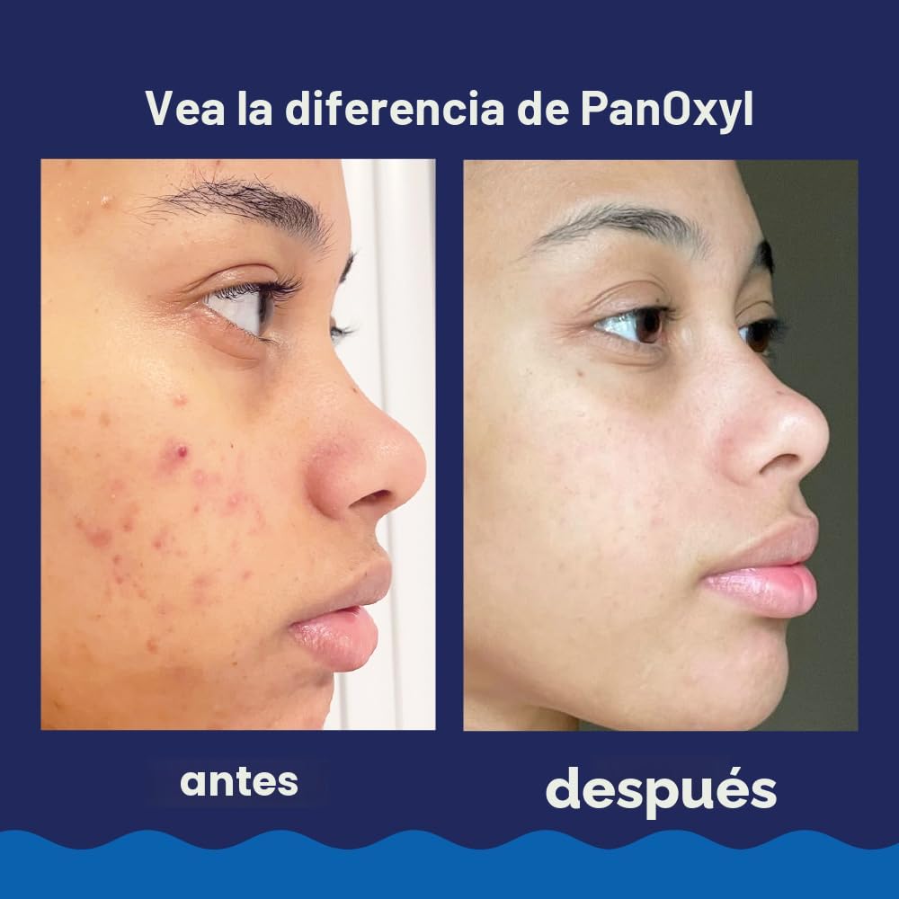 PanOxyl Lavado en Espuma - Peróxido de Benzoilo 10%
