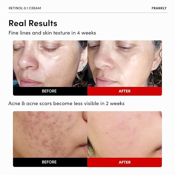FRANKLY Retinol 0.1% Crema, 1.01 fl oz - Retinol coreano para princ...