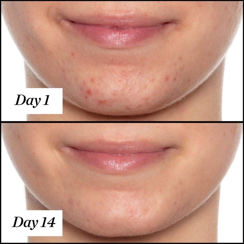 Sunday Riley Aceite facial para tratamiento del acné con ácido sali...