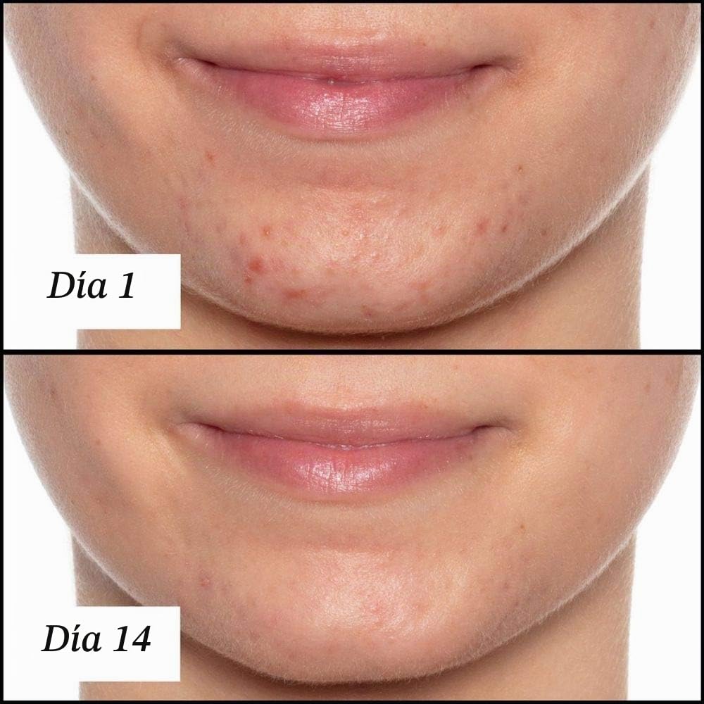Sunday Riley Aceite facial para tratamiento del acné con ácido sali...