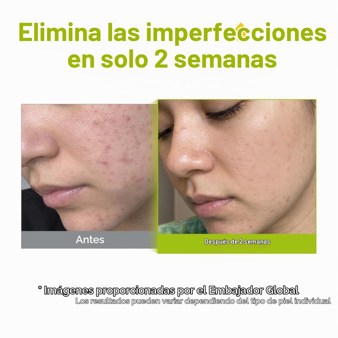 PURITO Azelaic 10% Suero Kójico para pieles sensibles, 1.01 fl.oz |...