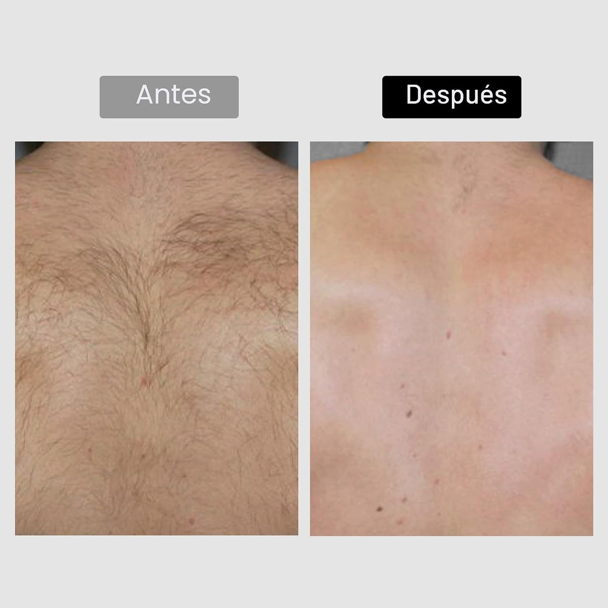 Retiro del pelo del laser del diodo, dispositivo del retiro del pel...