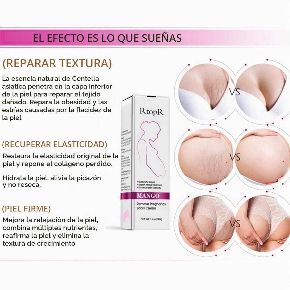 Crema para estrías y cicatrices de mango, crema para eliminar estrí...