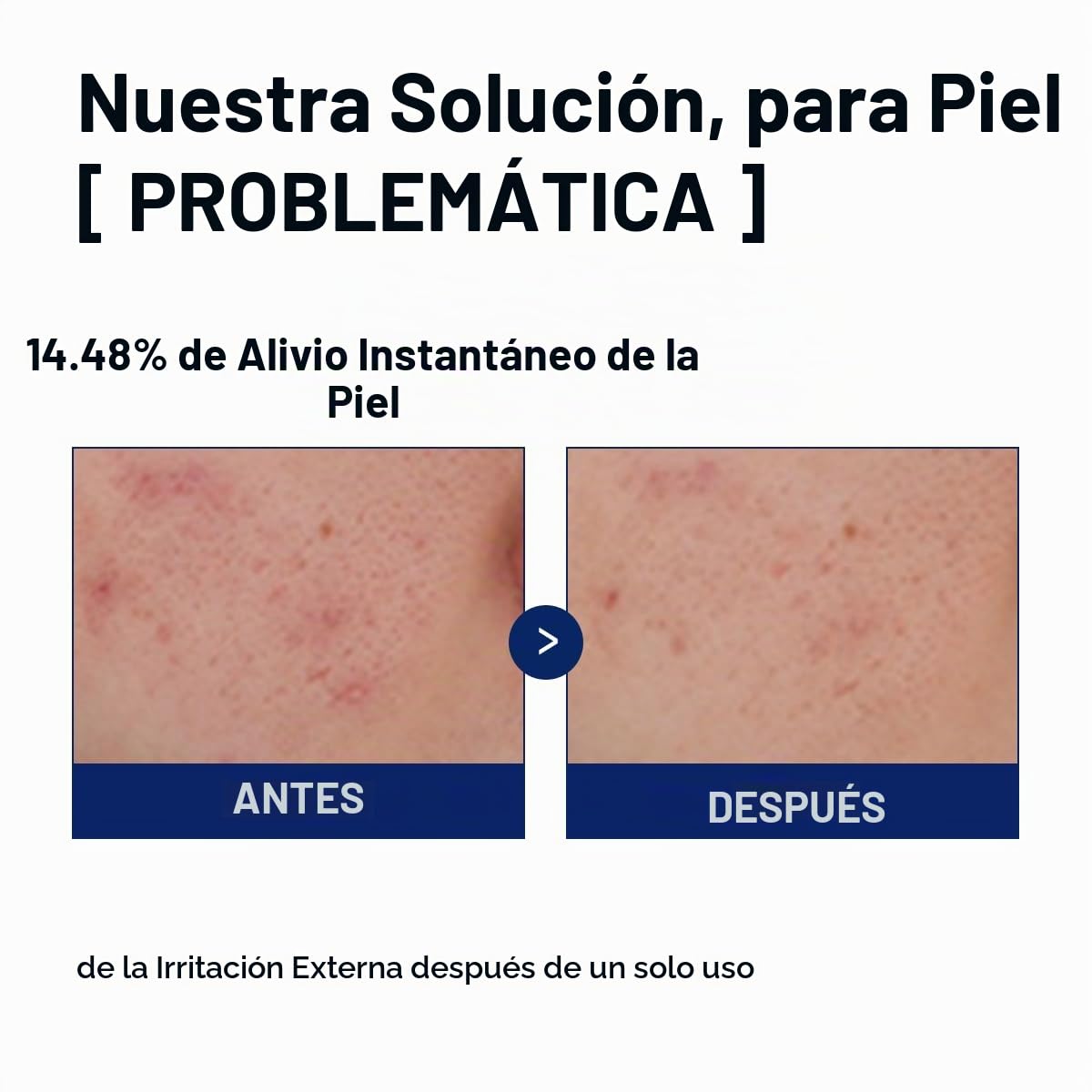 Suero Calmante Mediheal Teatree 1.35 onzas líquidas \u2013 Calma rá...