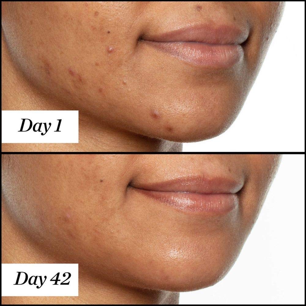 Sunday Riley Aceite facial para tratamiento del acné con ácido sali...