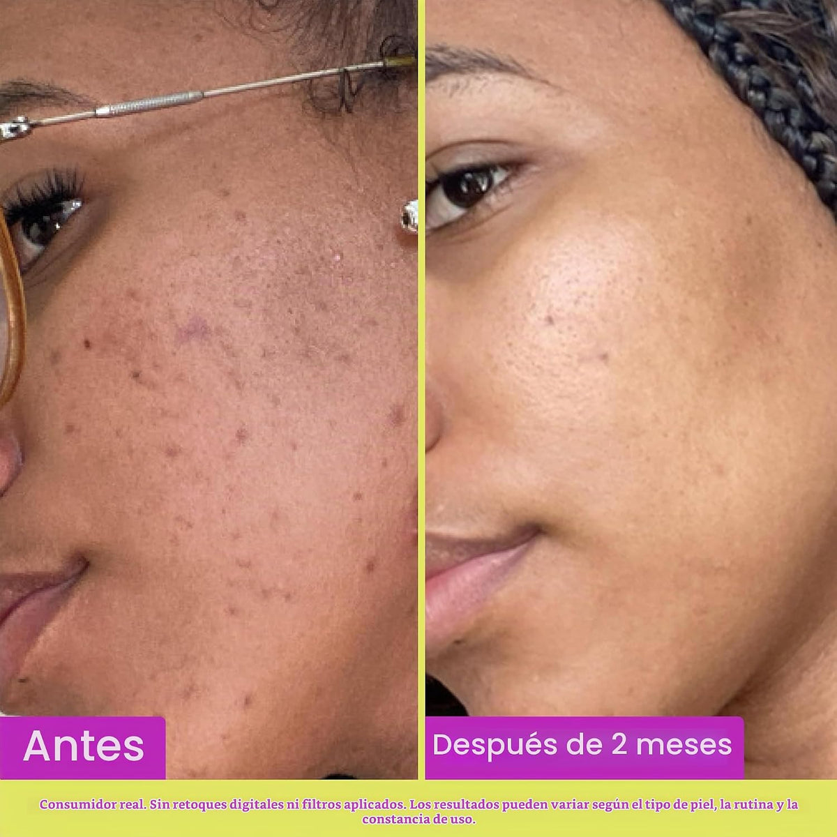 Good Molecules - Tratamiento de ácido azelaico al 10% para la cara,...
