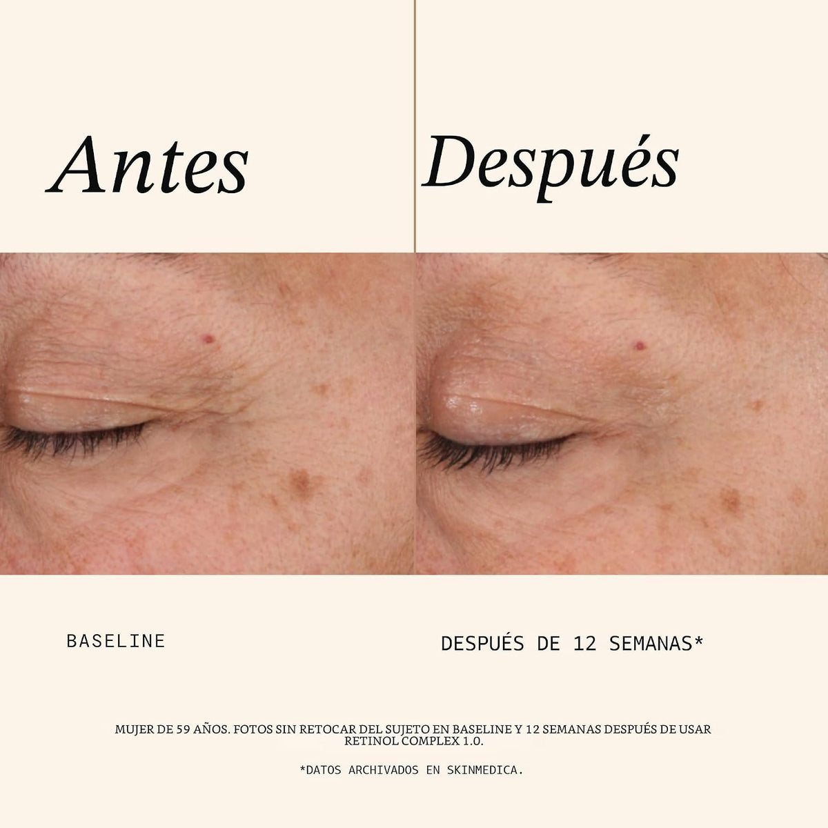 Complejo 1.0 de Defensa Anti Edad con Retinol de Skin Medica, 1 onz...