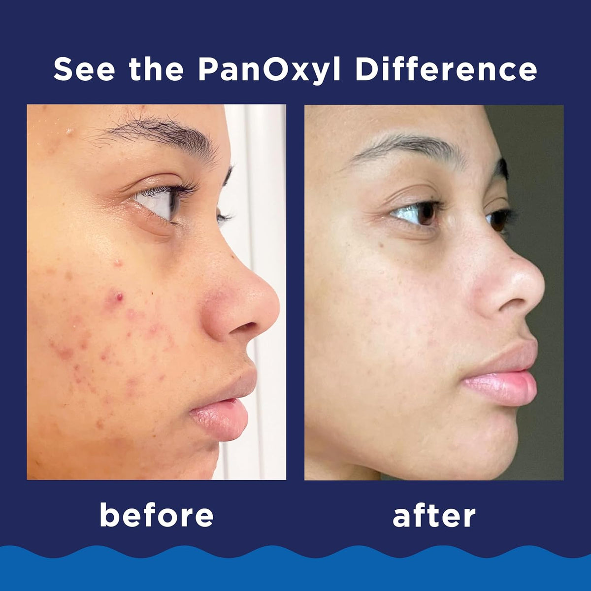 PanOxyl Espuma de Lavado Extra Fuerza - Peróxido de Benzoilo 10%