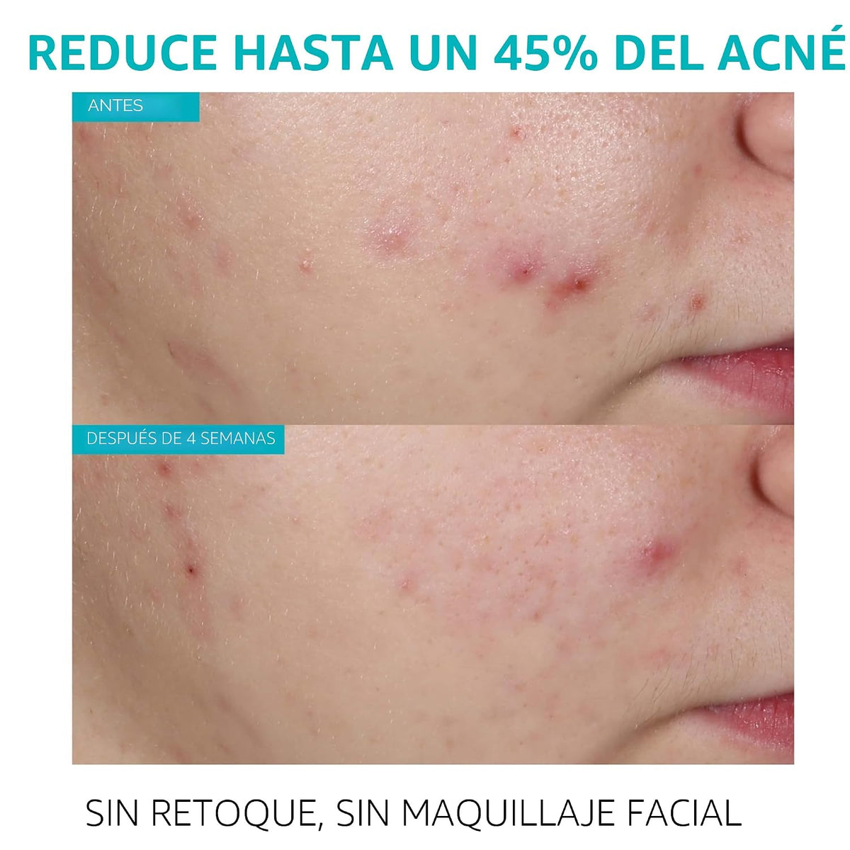 La Roche-Posay Effaclar - Suero de ácido salicílico al 1,5%, tratam...