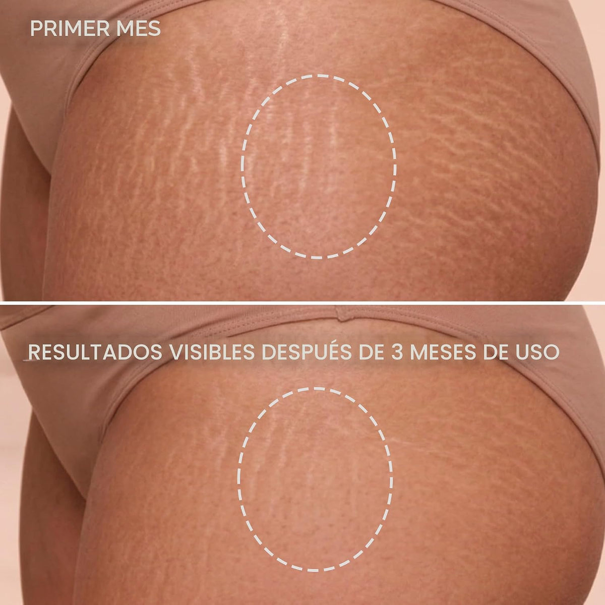 Cicatrissim Classic Stretch Mark Cream para estrías rojas y blancas...
