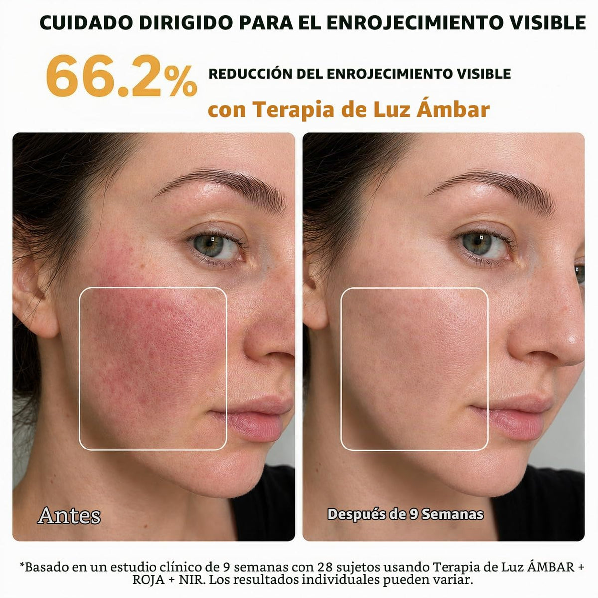 Terapia de luz azul aprobada por la FDA para el acné con inflamació...