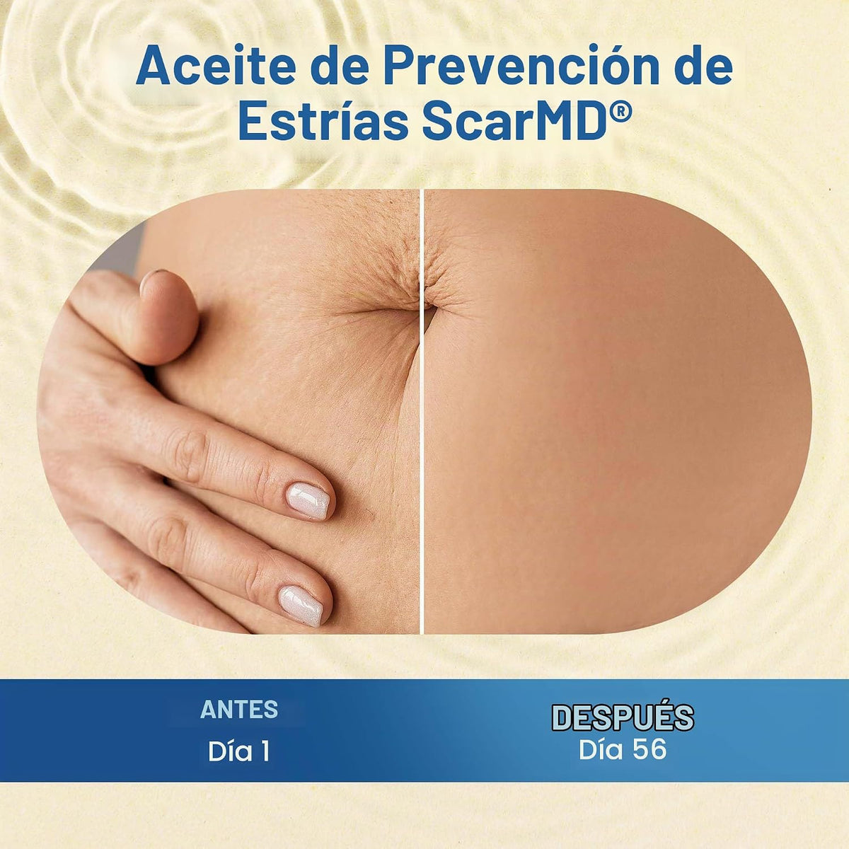 Aceite de estrías, minimiza el riesgo y la gravedad de las estrías,...