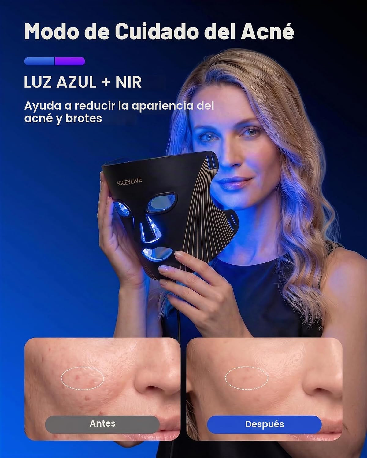 Terapia de luz azul aprobada por la FDA para el acné con inflamació...
