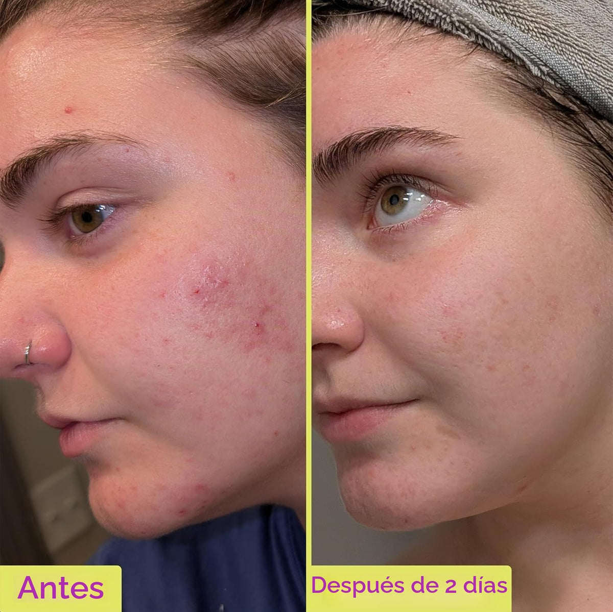 Good Molecules Paquete de Tratamiento de Ácido Azelaico 10% 2 \u201...