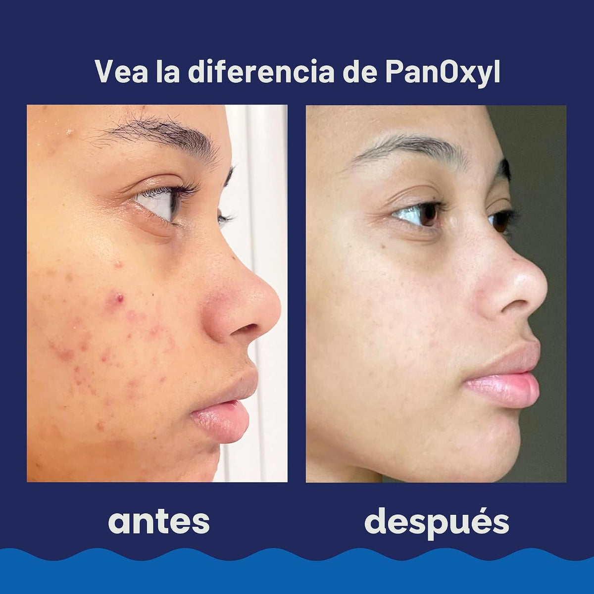 PanOxyl Lavado en Espuma - Peróxido de Benzoilo 10%