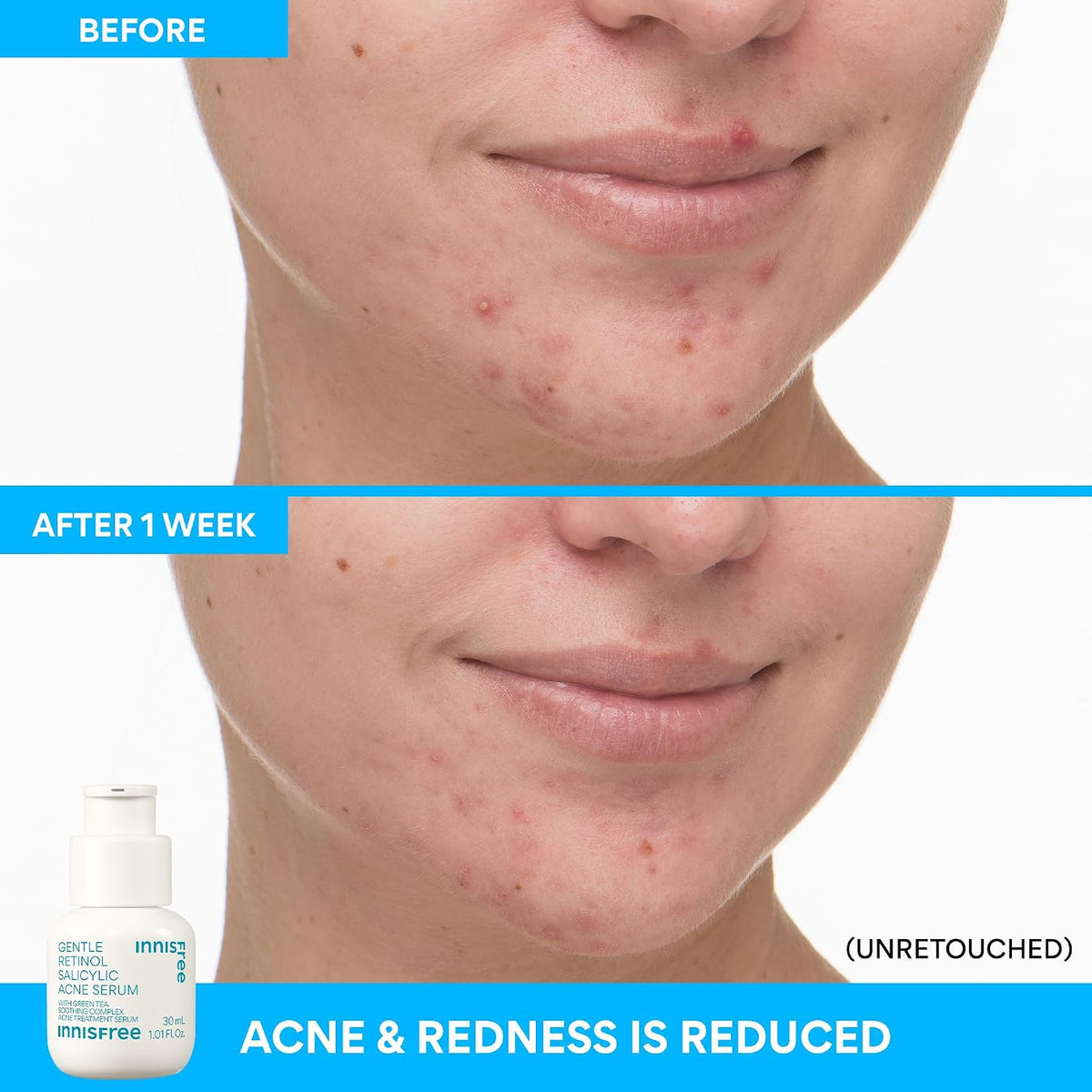 innisfree Suero para acné salicílico suave con retinol | Tratamient...