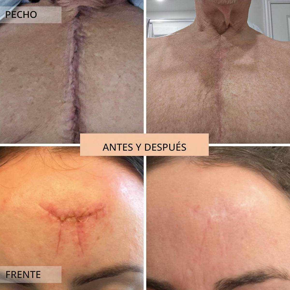 Skinuva® Crema para estrías (2.5 oz) | Ayuda a mejorar la aparienci...
