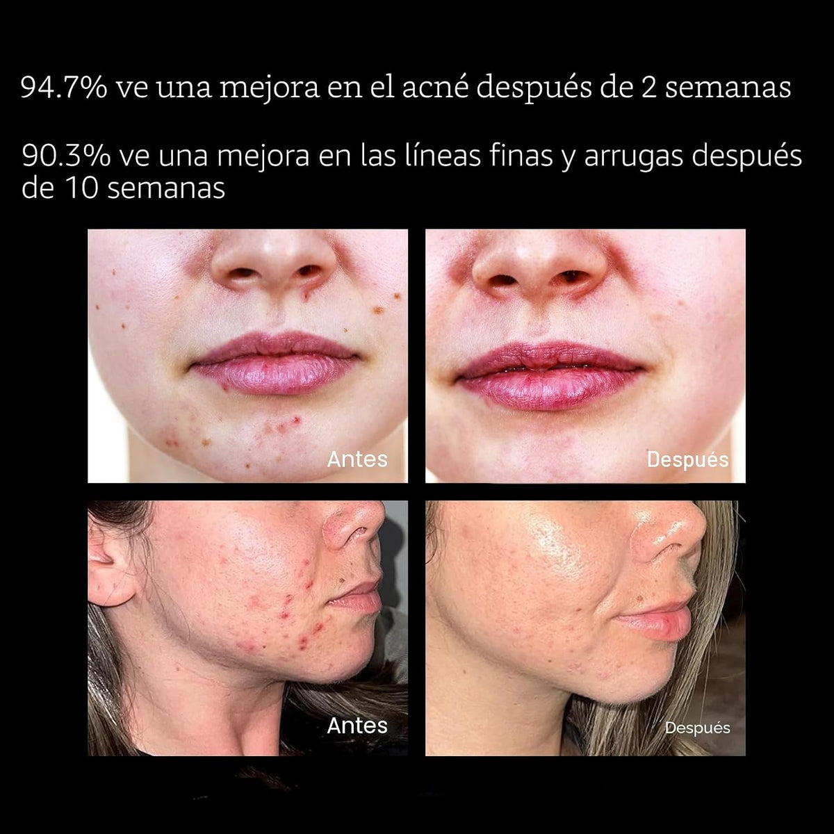 Aphrona MOONLIGHT PRO - Máscara facial con luz LED aprobada por la...