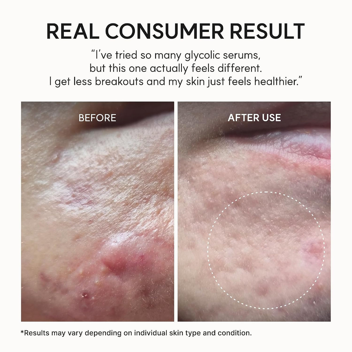 Arencia Erasor Shot - Suero potenciador de ácido glicólico y crema...