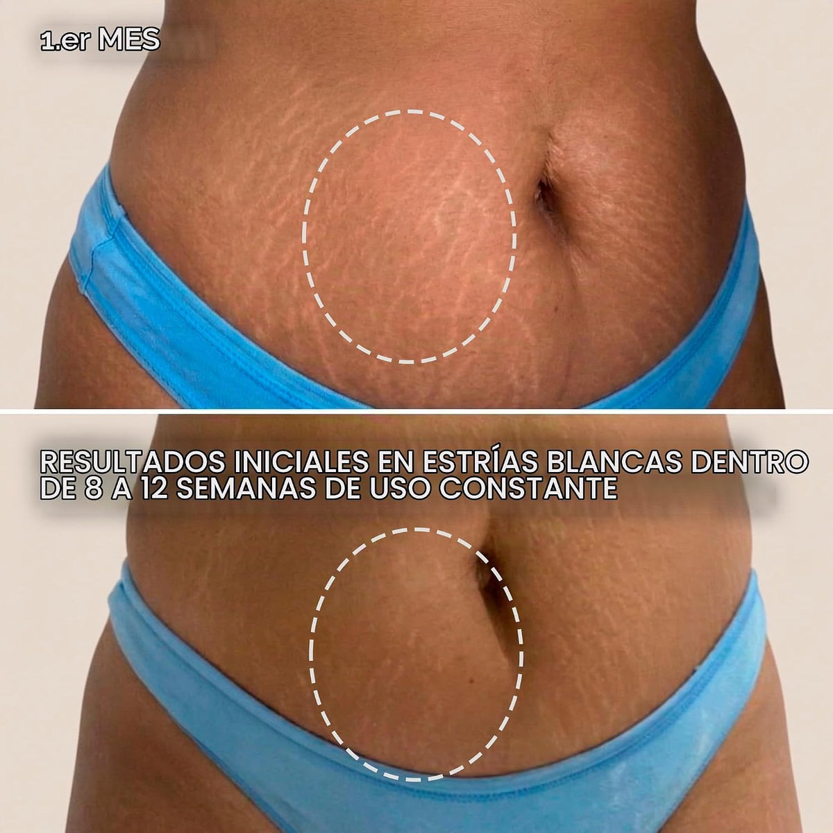 Crema de estrías dirigida Cicatrissim para estrías blancas, 5.3 onz...