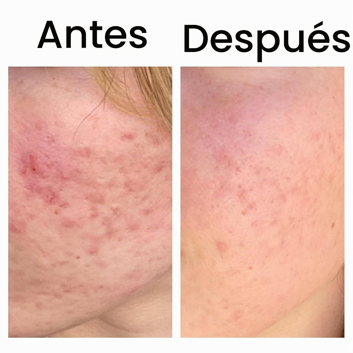 The INKEY List SuperSolutions Ácido Azelaico 10% Suero 1.01 fl oz |...