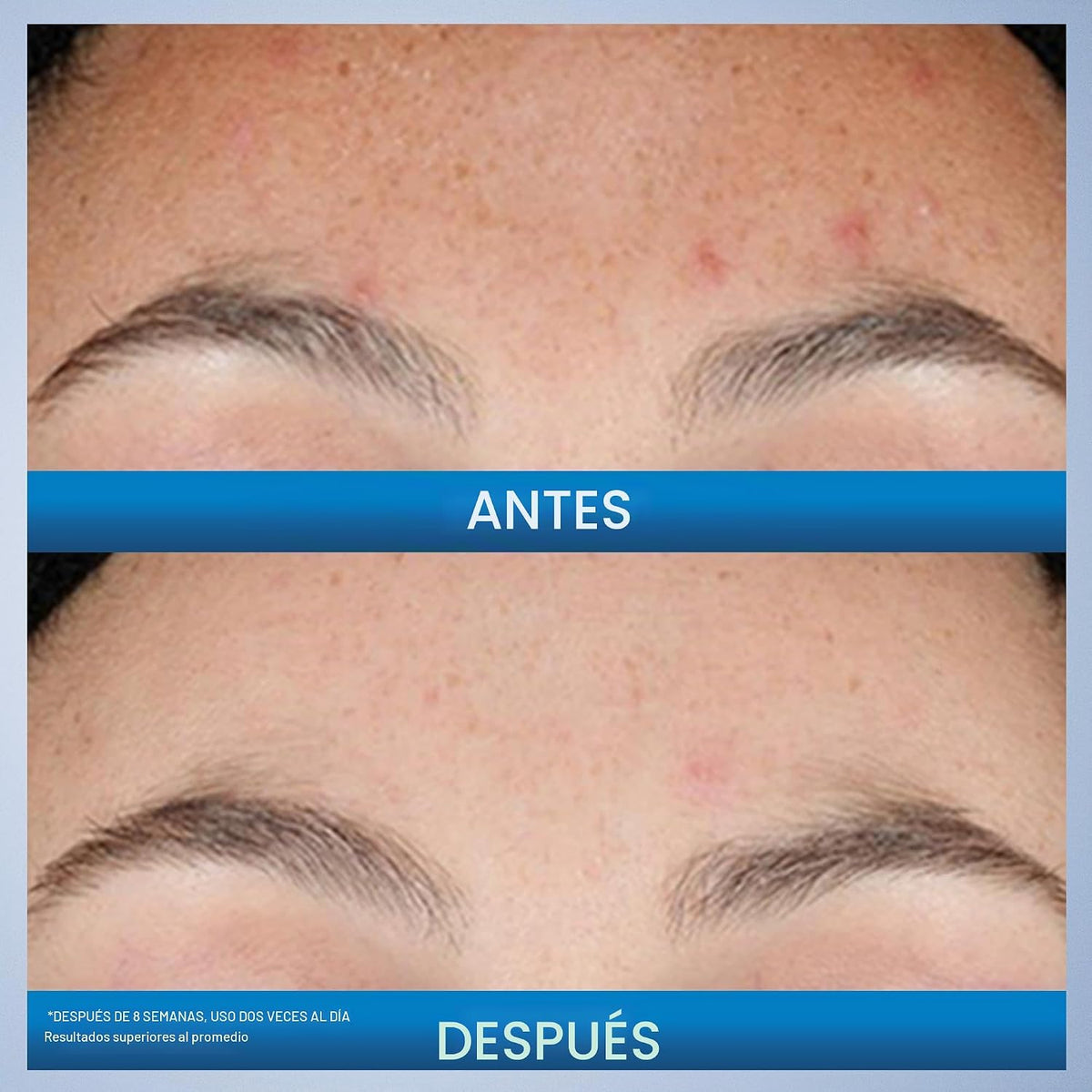 CeraVe Suero de Retinol Renovador para Marcas Post-Acné, Formulado...