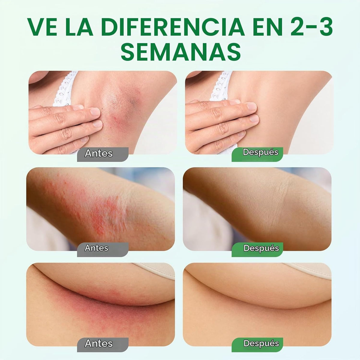 CLFJLXYX Crema Intertrigo, Crema Rociante para Cuidado del Pliegue...