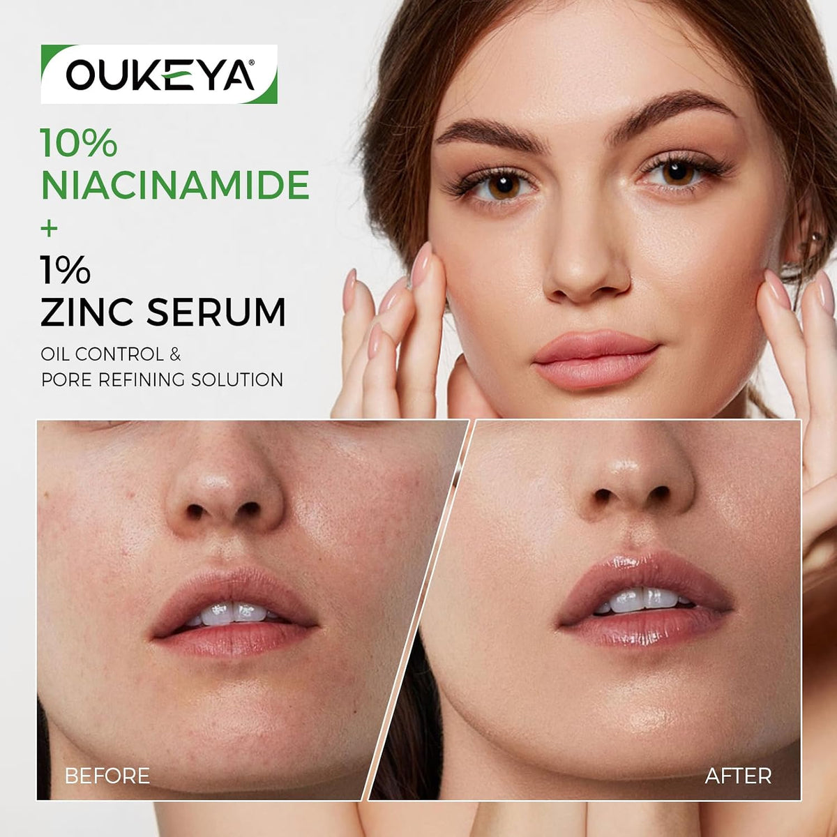 OUKEYA Suero de niacinamida al 10%, zinc PCA y ácido hialurónico -...