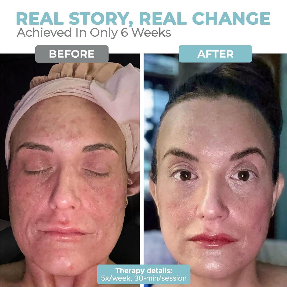 Nourished Bodynskin Máscara facial y cuello con terapia de luz LED,...