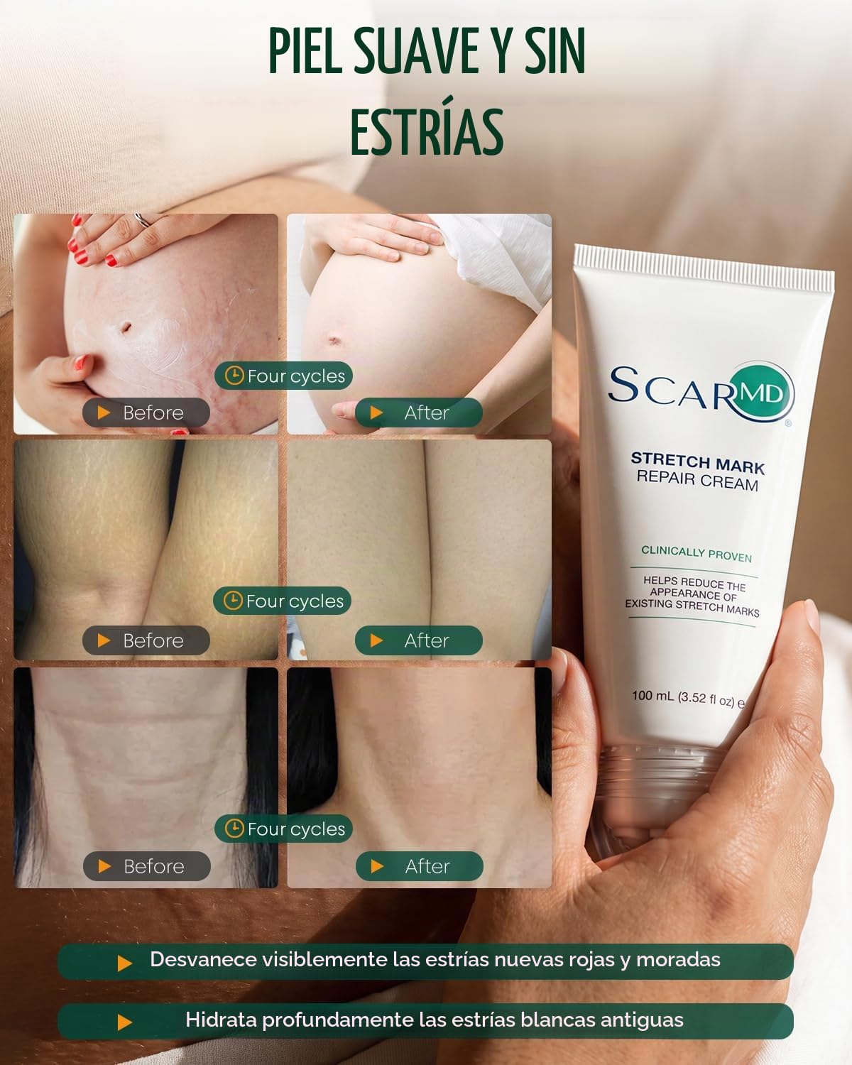 ScarMD Crema para estrías, desarrollada y fabricada en Estados Unid...