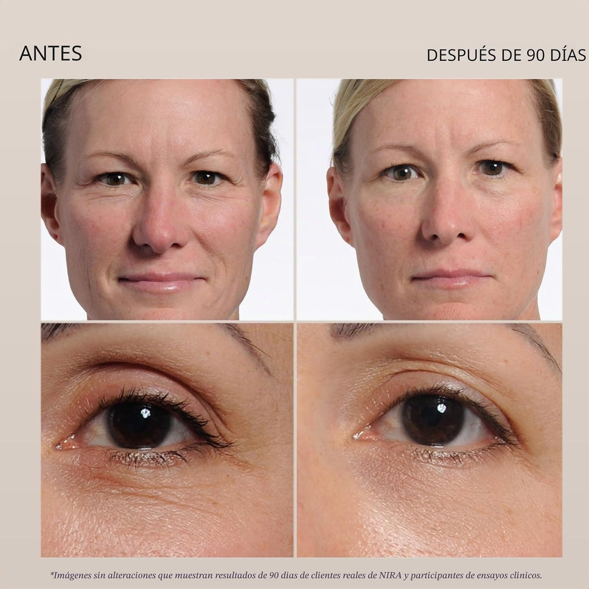 NIRA Terapia de luz láser de la FDA, antienvejecimiento, resultado...