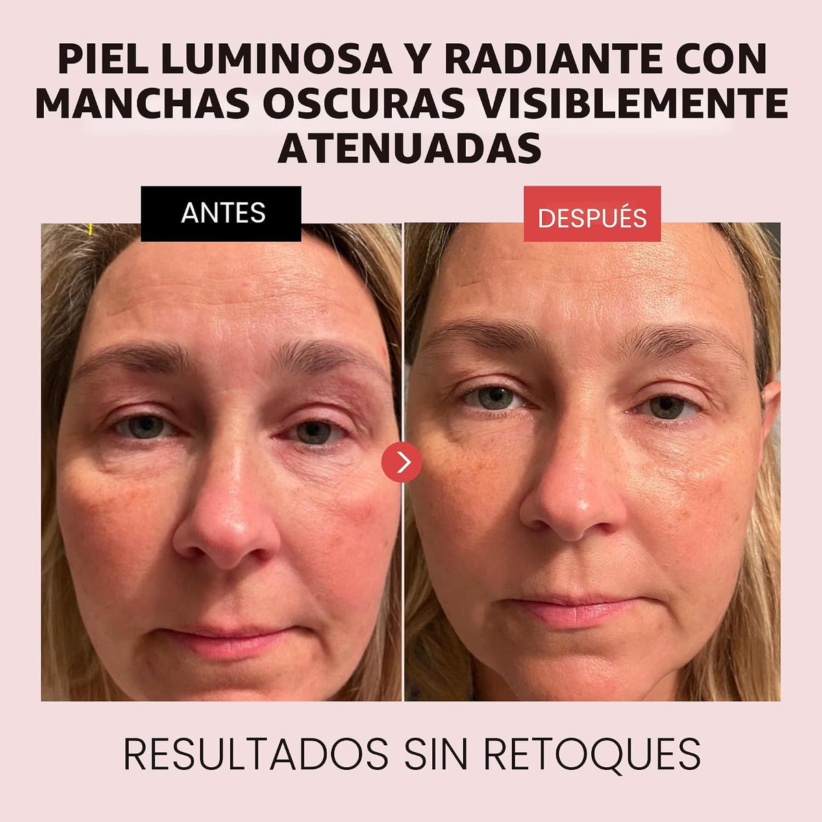 Suero de retinol al 2,5% para la cara - Tratamiento de cicatrices d...