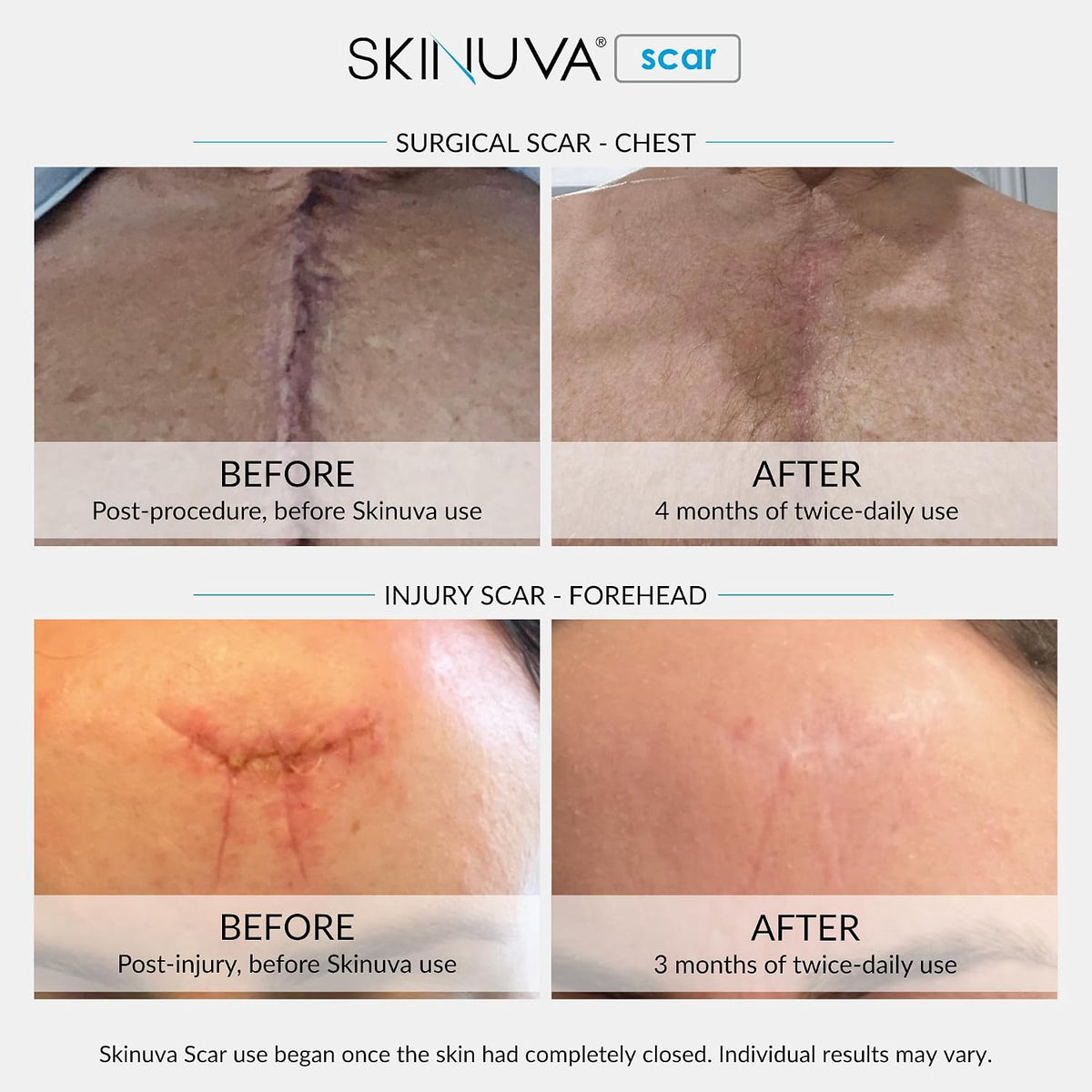 Skinuva® Crema para cicatrices para cara y cuerpo (1.5 onzas) (paqu...