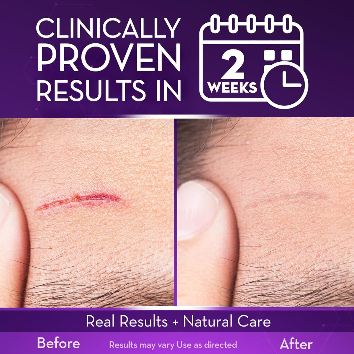 Cicatricure Gel de cicatriz avanzado, resultados probados en 2 sema...