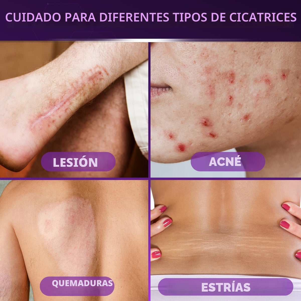 Cicatricure Advanced Scar Gel, resultados comprobados en 2 semanas,...