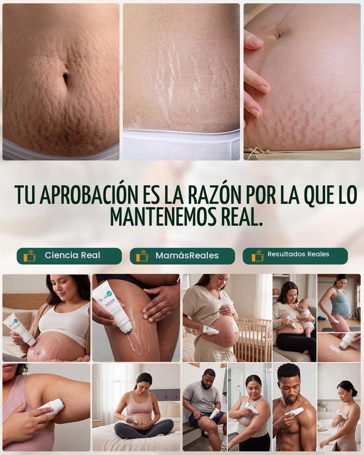 ScarMD Crema para estrías, desarrollada y fabricada en Estados Unid...