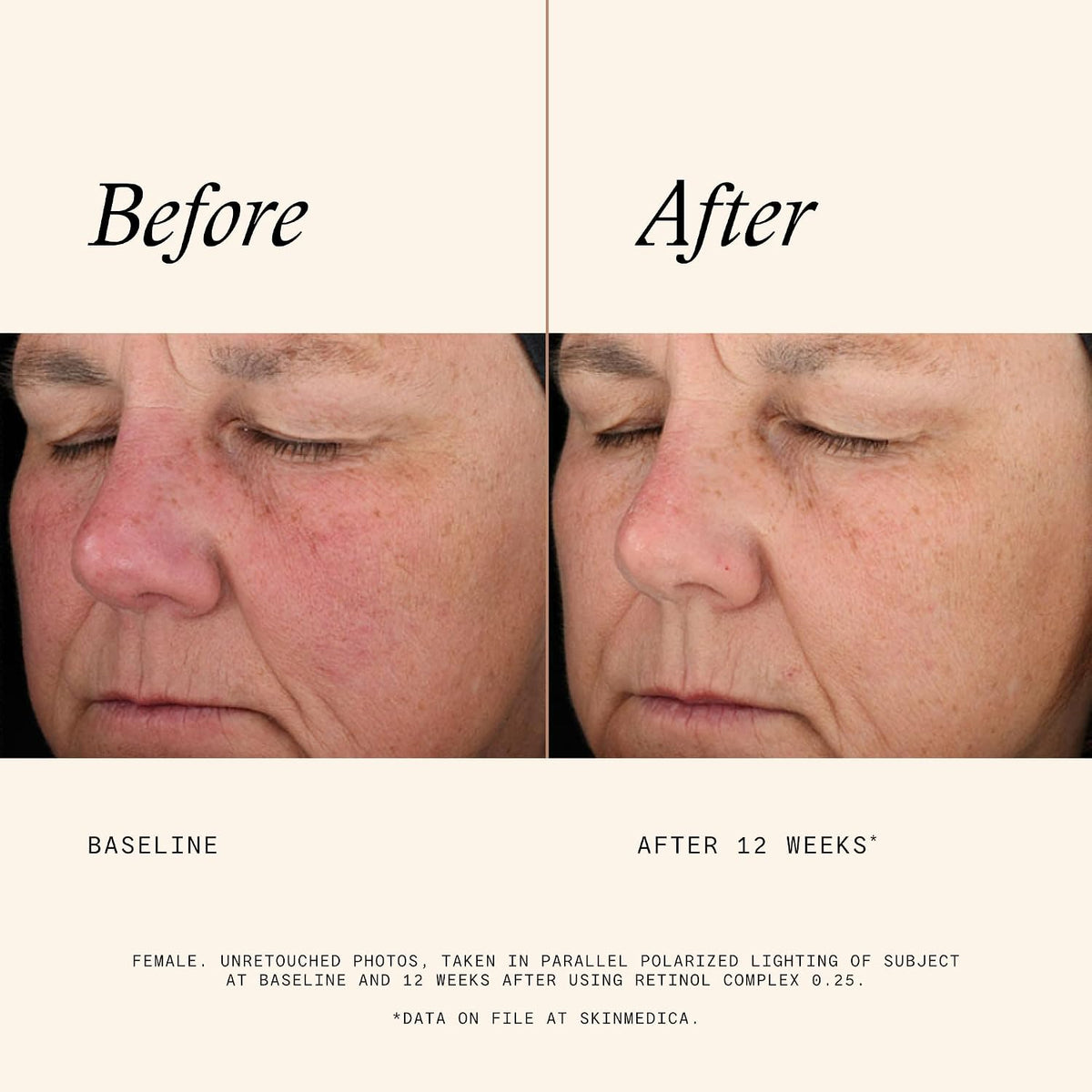SkinMedica Retinol Serum 0.25 Complex - Suero para la cara, crema d...