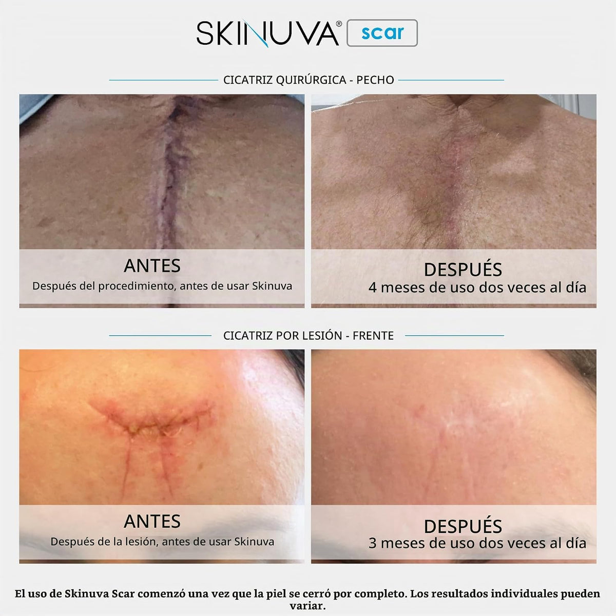 Skinuva® Crema para cicatrices nuevas y viejas (1 oz) | Ayuda a des...