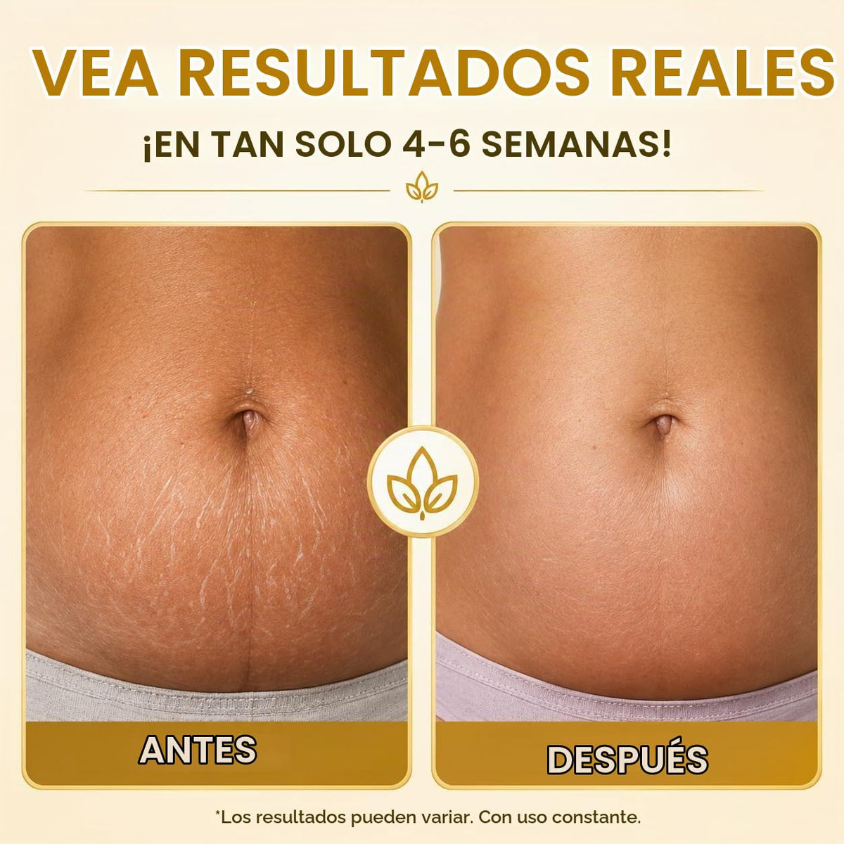 Aceite corporal de estrías para embarazo y cicatrices, aceite natur...
