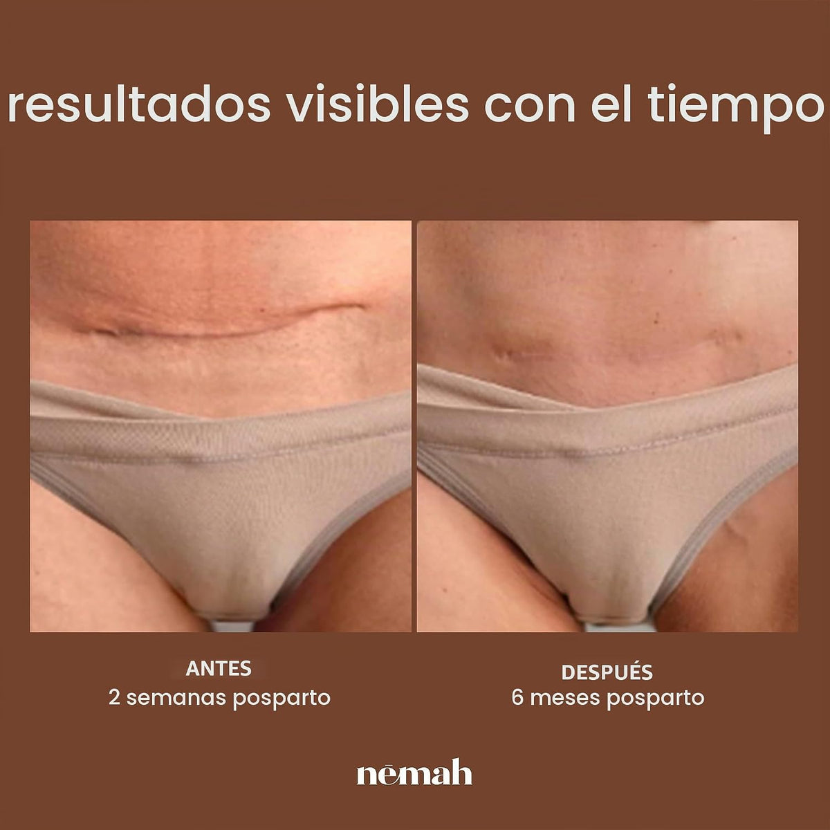 Nemah Tratamiento restaurador de cicatrices, recuperación de secció...