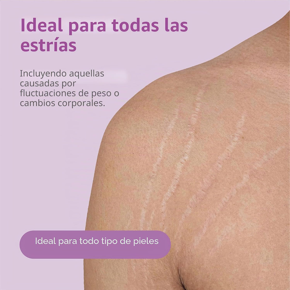 Crema para las estrías TriLASTIN-SR potente para reducir estrías pr...