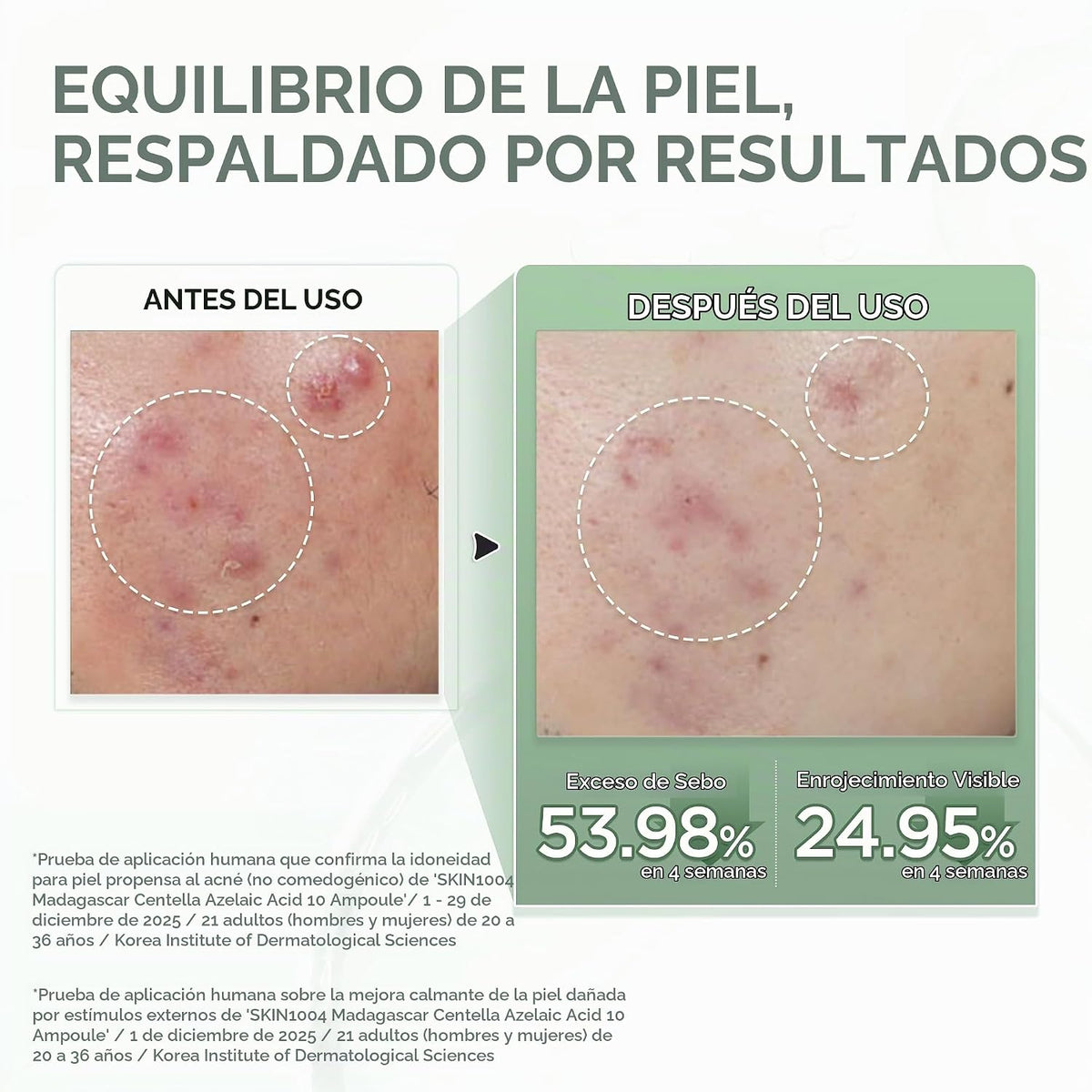 SKIN1004 Ampolla de ácido azelaico al 10%, suero facial coreano cen...