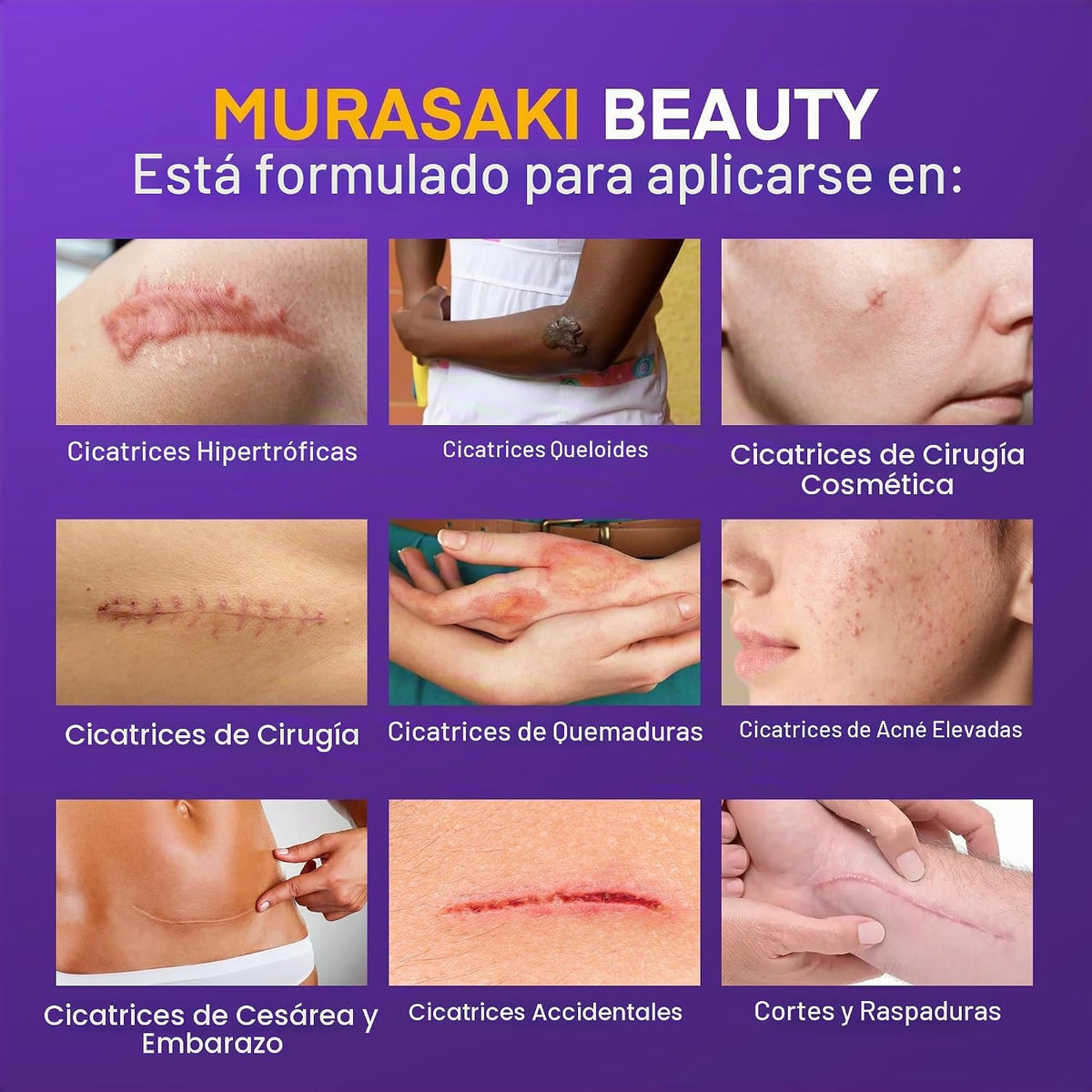 Crema de silicona para cicatrices de gel para cicatrices, SPF 30 fó...
