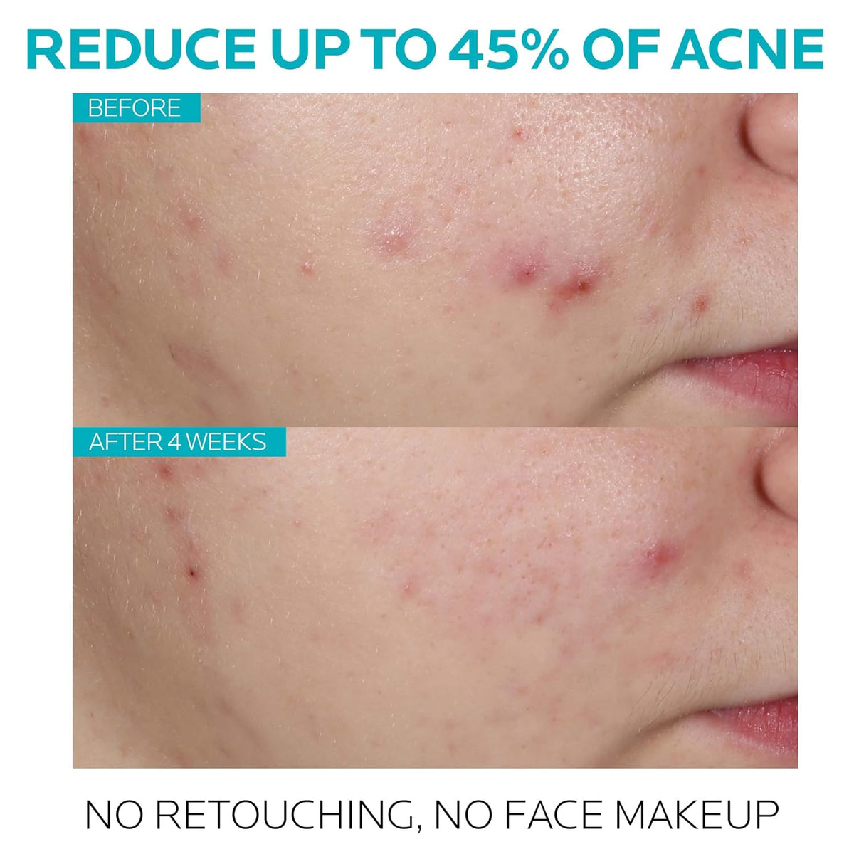 La Roche-Posay Effaclar - Suero de ácido salicílico al 1,5%, tratam...