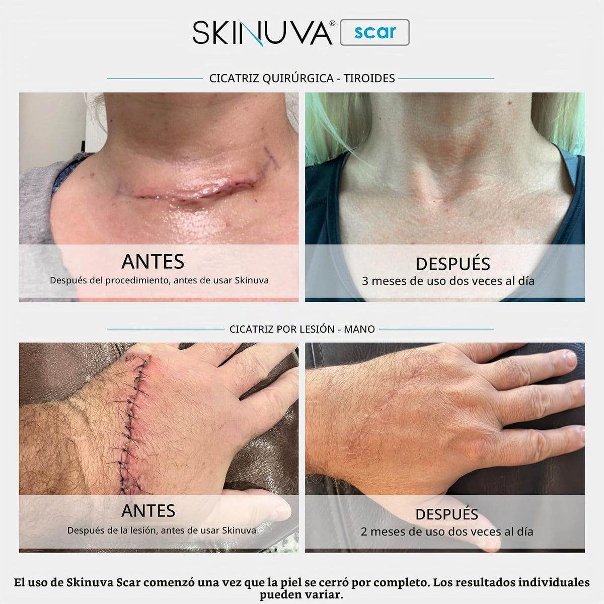 Skinuva® Crema para cicatrices nuevas y viejas (1 oz) | Ayuda a des...