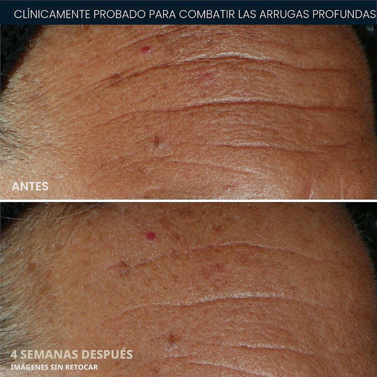 RoC Derm Correxion Fill+Treat Retinol Serum, relleno profundo de ar...