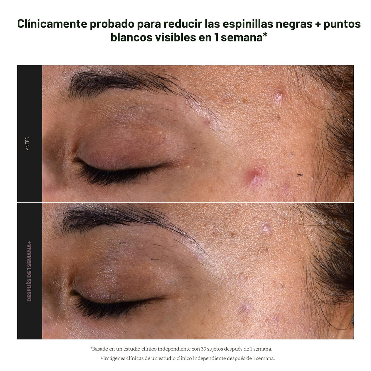 Paula's Choice SKIN PERFECTING 2% BHA Exfoliante líquido sin enjuag...