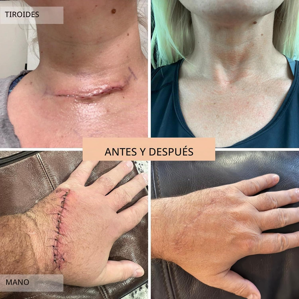Skinuva® Crema para estrías (2.5 oz) | Ayuda a mejorar la aparienci...